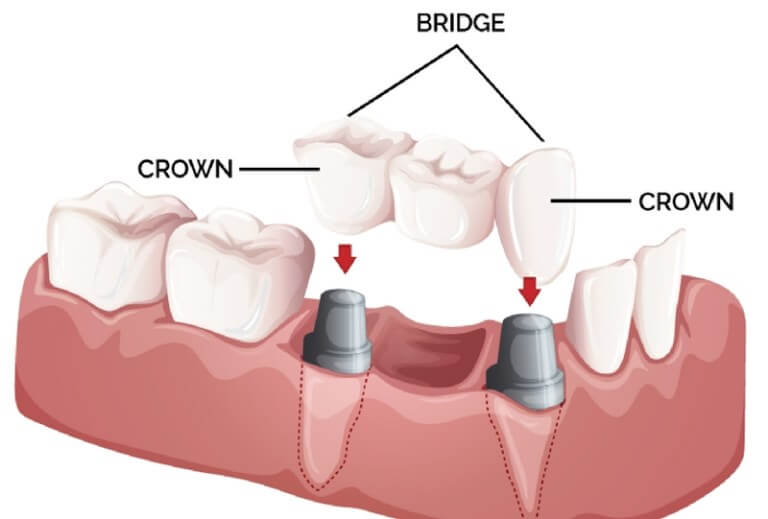Dental Implant Procedure