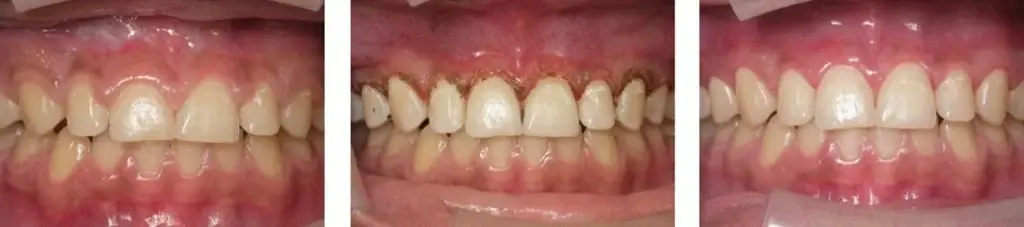 Laser Gingivectomy Procedure