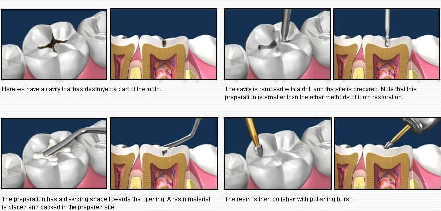 Tooth Restoration Procedure